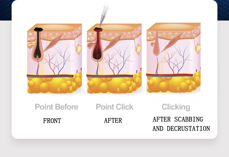 Digital Fibroblast Plasma Beauty Pen