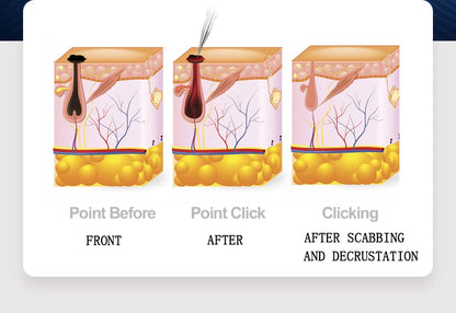 Digital Fibroblast Plasma Beauty Pen
