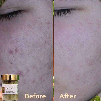 women_fashion - littlescollectionFace tightening productsSolution with Herbal Acne Kit for Face